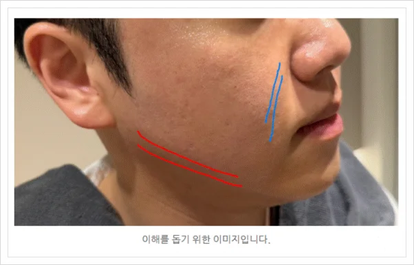 피부 처짐과 턱선 라인을 표시한 환자 측면 얼굴 이미지