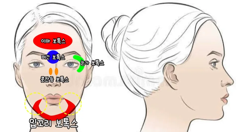 이마, 미간, 눈가, 콧잔등, 입꼬리 보톡스 시술 위치를 정면과 측면 얼굴에 표시한 일러스트